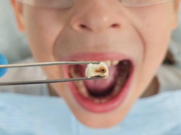 Best Emergency Tooth Extraction in Flagtown, NJ